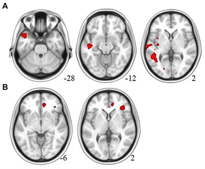 Comparative study on structural and functional brain differences in mild cognitive impairment patients with tinnitus